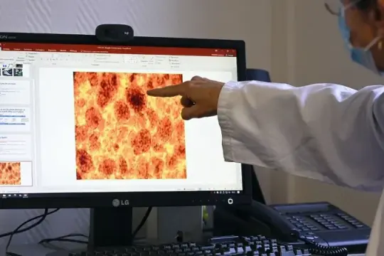 الموافقة على دواء جديد يضاعف أعمار مرضى سرطان البنكرياس