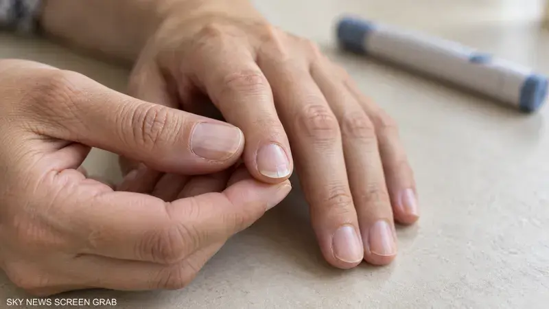 الدراسة رصدت ارتباطًا بين استخدام الأدوية ومشكلات الأظافر