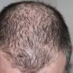 علماء يقتربون من علاج نهائي للصلع بعد اكتشاف مصل يُعيد نمو الشعر خلال 20 يوماً