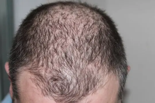 علماء يقتربون من علاج نهائي للصلع بعد اكتشاف مصل يُعيد نمو الشعر خلال 20 يوماً