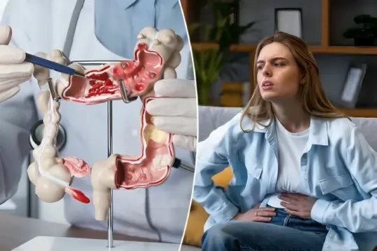 دراسة أميركية تربط الوجبات السريعة واللحوم المصنعة بارتفاع خطر سرطان القولون لدى النساء