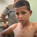 تحذيرات من تفشي جدري الماء بين أطفال النازحين في قطاع غزة وسط أوضاع صحية متدهورة