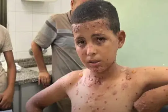 تحذيرات من تفشي جدري الماء بين أطفال النازحين في قطاع غزة وسط أوضاع صحية متدهورة