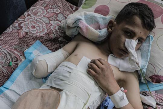 42 ألف شخص في قطاع غزة يعانون إصابات غيّرت مجرى حياتهم