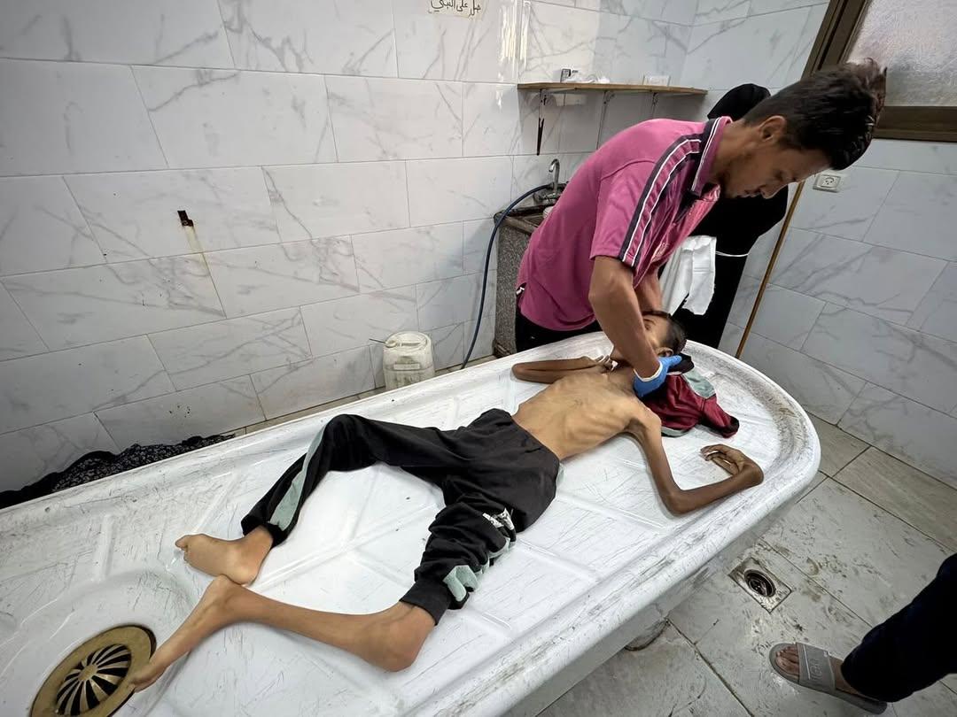 وفاة مواطنين نتيجة المجاعة وسوء التغذية خلال الساعات الـ24 الماضية