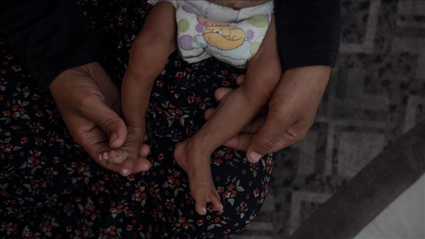 "أونروا": حالات سوء التغذية بين الأطفال في غزة زادت بمقدار 3 مرات