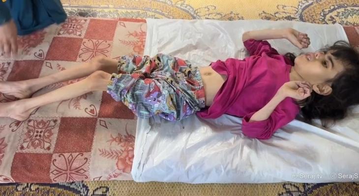 استشهاد الطفلة رزان أبو زاهر بسبب سوء التغذية بغزة