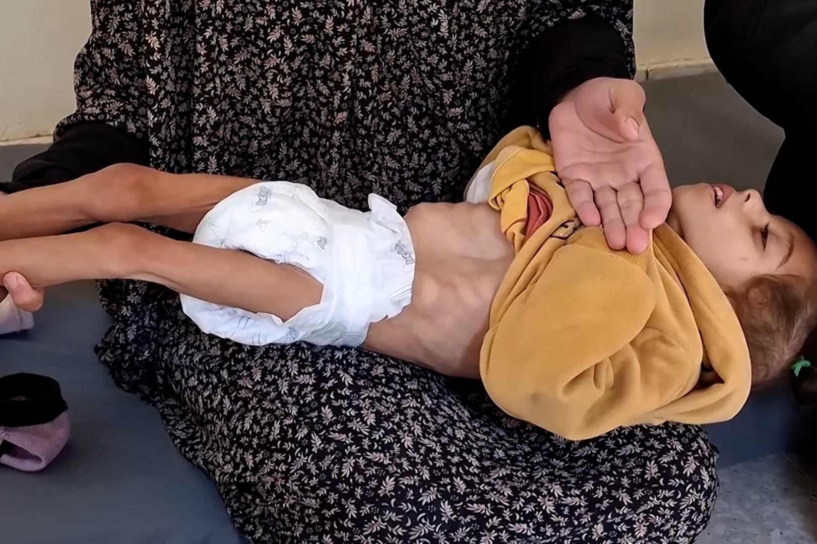 الحالات في تزايد.. أونروا: طفل من 5 أطفال بغزة يعاني من سوء التغذية