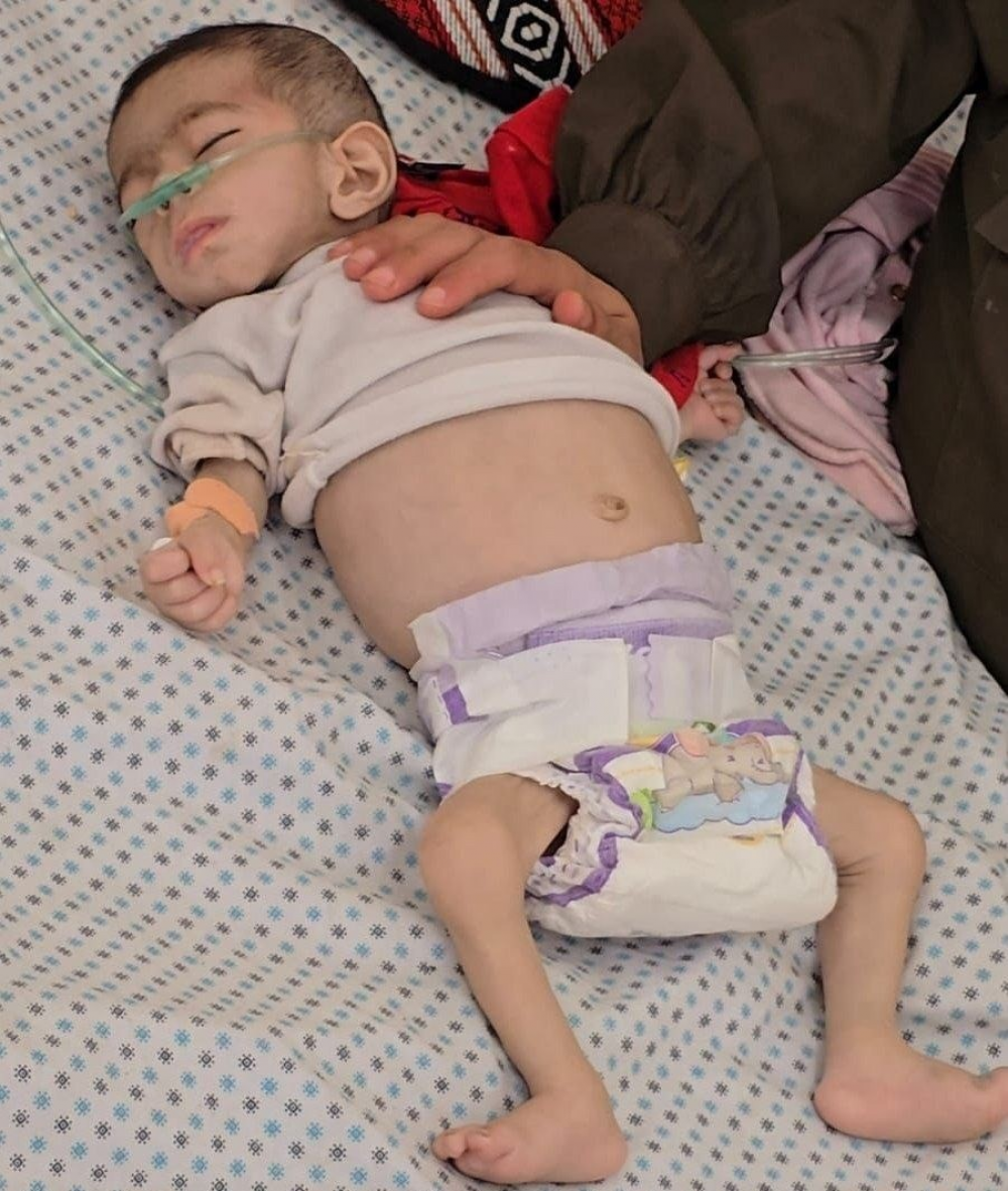 ارتفاع عدد شهداء المجاعة وسوء التغذية بغزة إلى 217