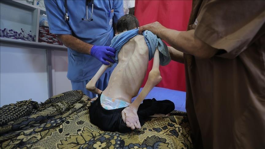 ارتفاع وفيات التجويع الإسرائيلي إلى 162 فلسطينيا بينهم 92 طفلا