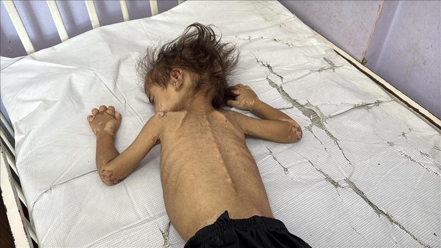 ارتفاع ضحايا شهداء التجويع الإسرائيلي في غزة إلى 404 فلسطينيين