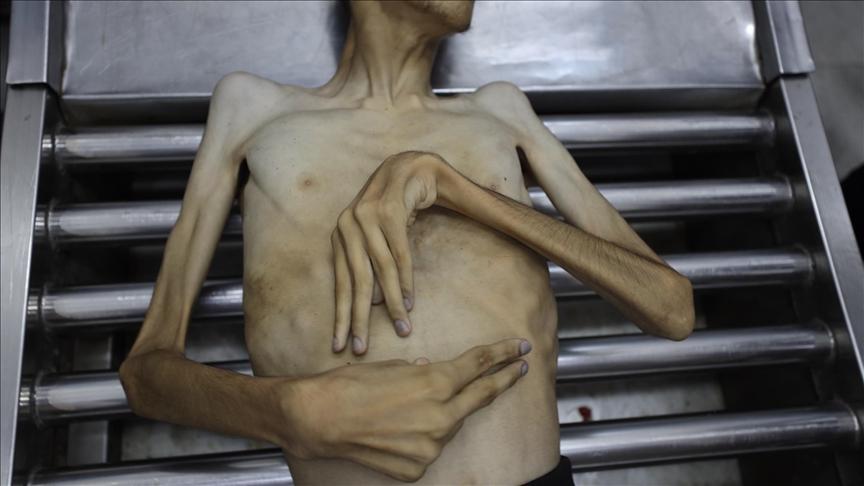 صحة غزة: حصيلة وفيات التجويع الإسرائيلي 322 بينهم 121 طفلا