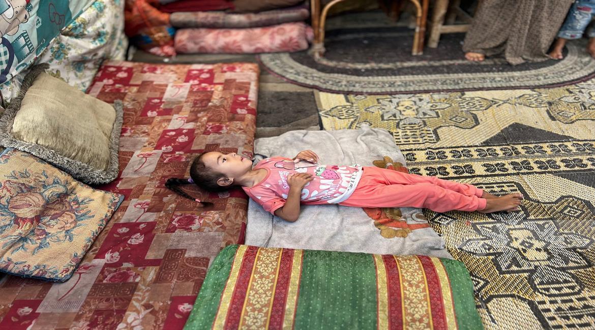 الأمم المتحدة: سوء التغذية الحاد بين الأطفال بغزة وصل أعلى مستوى