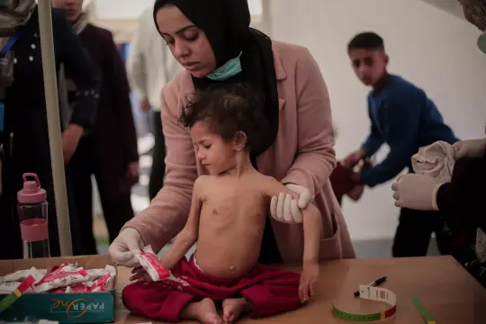تحذيرات طبية من تفاقم كارثة سوء التغذية بين أطفال غزة