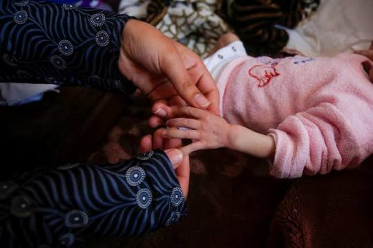 أطفال الحرب.. تشوهات وألم يرافق أول نفس في غزة