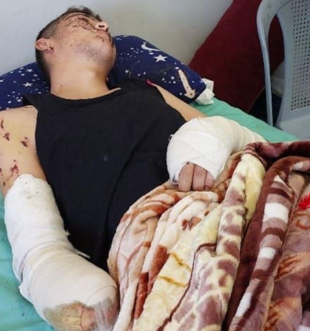 شاب يفقد يده وبصره جزئياً بعد انفجار جسم مشبوه في حي الشيخ رضوان وسط تحذيرات من اتساع الكارثة الإنسانية