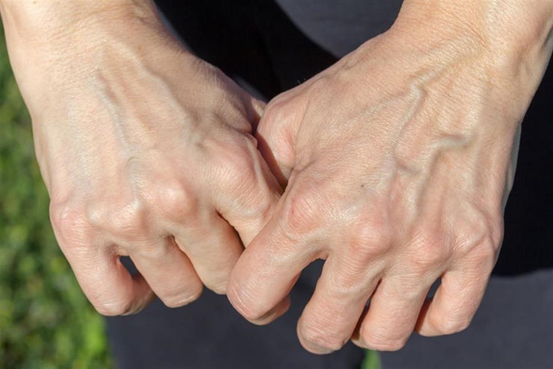هل تظهر العروق في بعض أجزاء جسمك؟ إليك الأسباب