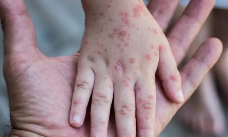 بريطانيا تُطالب مخالطي مرضى جدري القرود بالعزل 3 أسابيع
