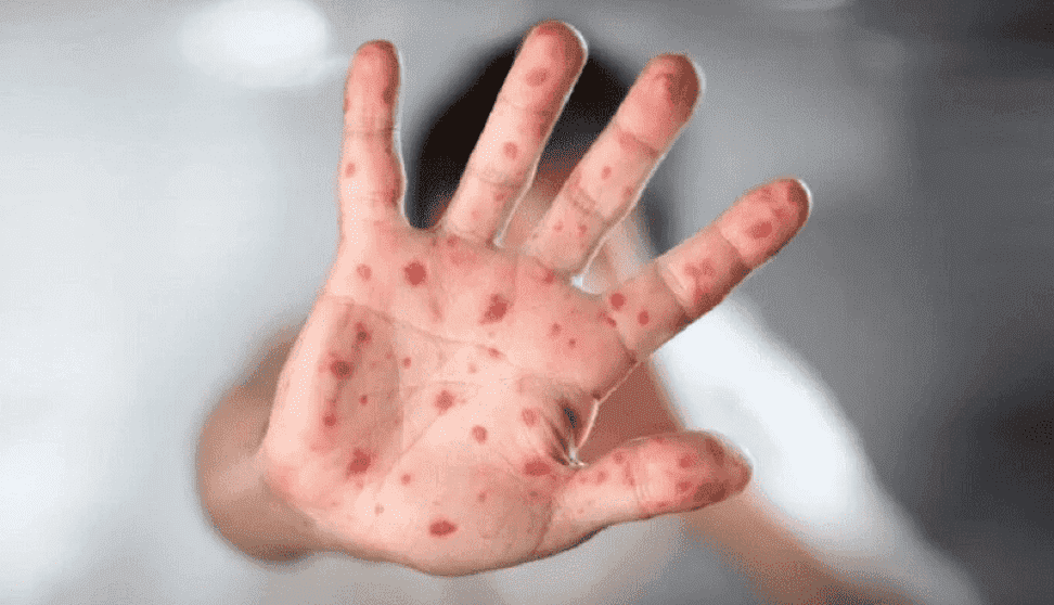 الصحة الإماراتية تسجل أول مصاباً بجدري القردة