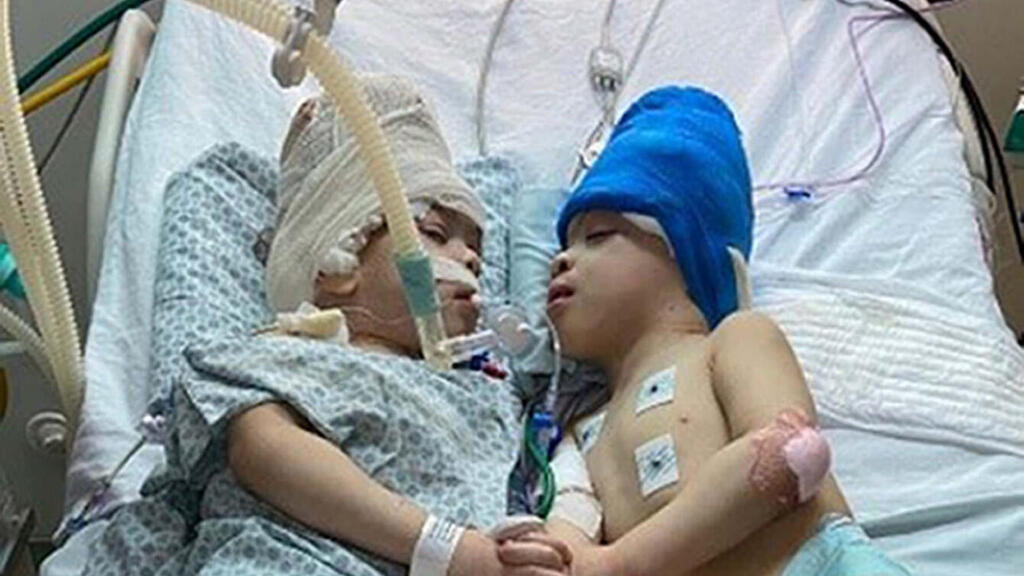 أطباء ينجحون فصل توأمين ملتصقين بعمر ثلاث سنوات في البرازيل