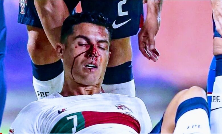 الدماء انهالت من وجهه.. رونالدو يتعرض لإصابة قوية