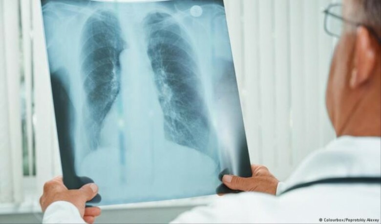 التهاب رئوي مجهول المصدر يقتل شخصين في الأرجنتين