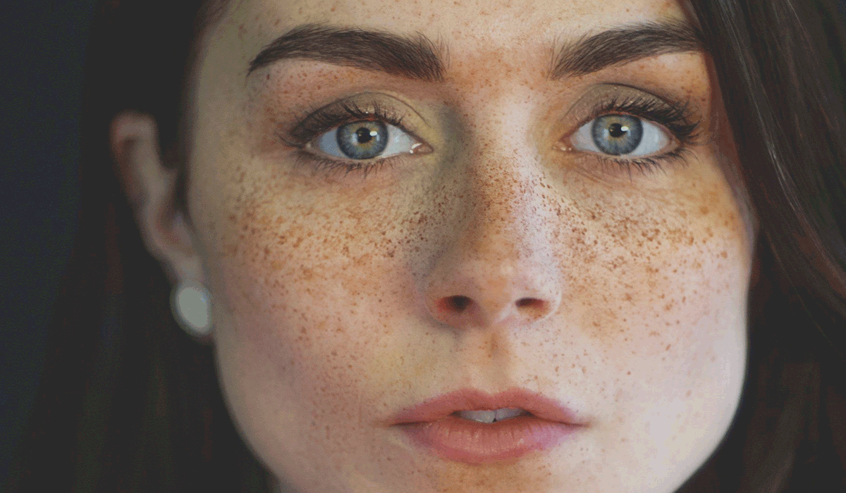 ما هي أسباب ظهور النمش؟ وإليك الطرق الشائعة لعلاجه