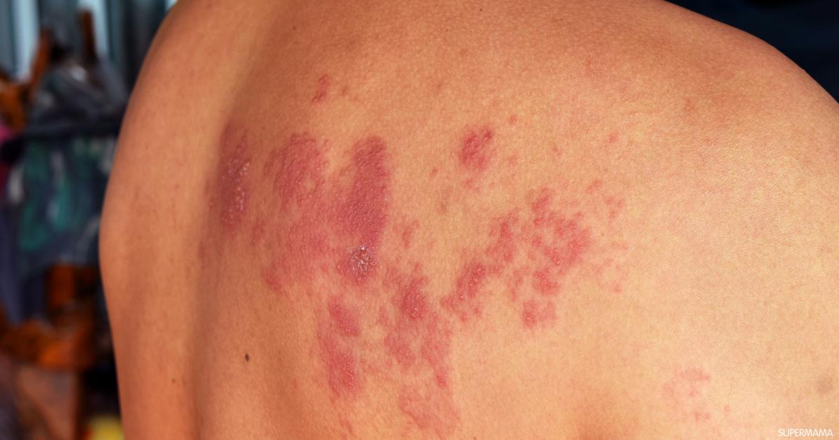 علاجات فعّالة تُسرع شفاء الحزام الناري