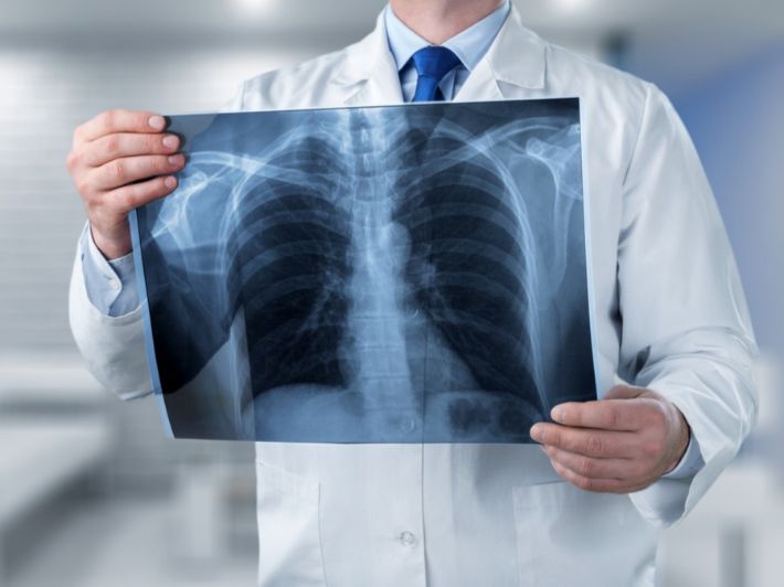 فحص بسيط بالأشعة السينية يكشف خبايا صحة القلب ويحد من مخاطر النوبات