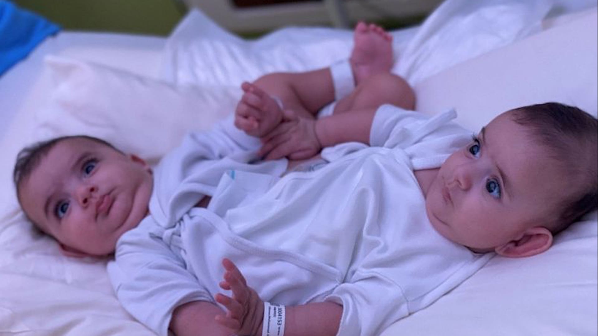 بعد عملية استغرقت 7 ساعات.. السعودية تنجح بفصل توأم سيامي