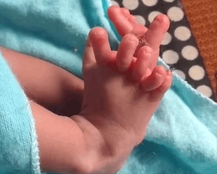 كثرة الأصابع حالة نادرة.. ولادة طفل بـ 26 إصبعاً في الهند