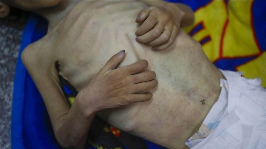مجاعة غزة .. وفاة 9 فلسطينيين بسوء التغذية خلال 24 ساعة