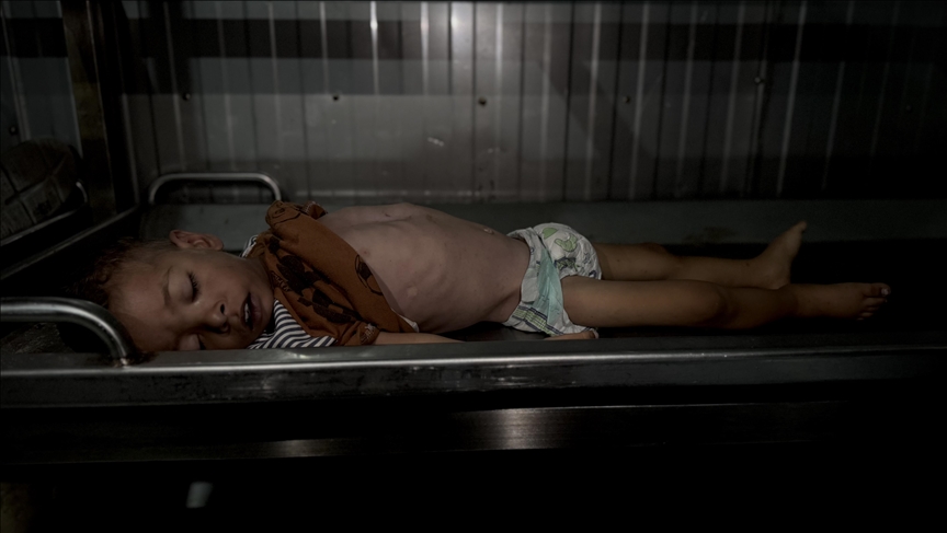 تحذيرات طبية من تصاعد خطير في حالات الشلل الرخو الحاد ومتلازمة غيلان باريه