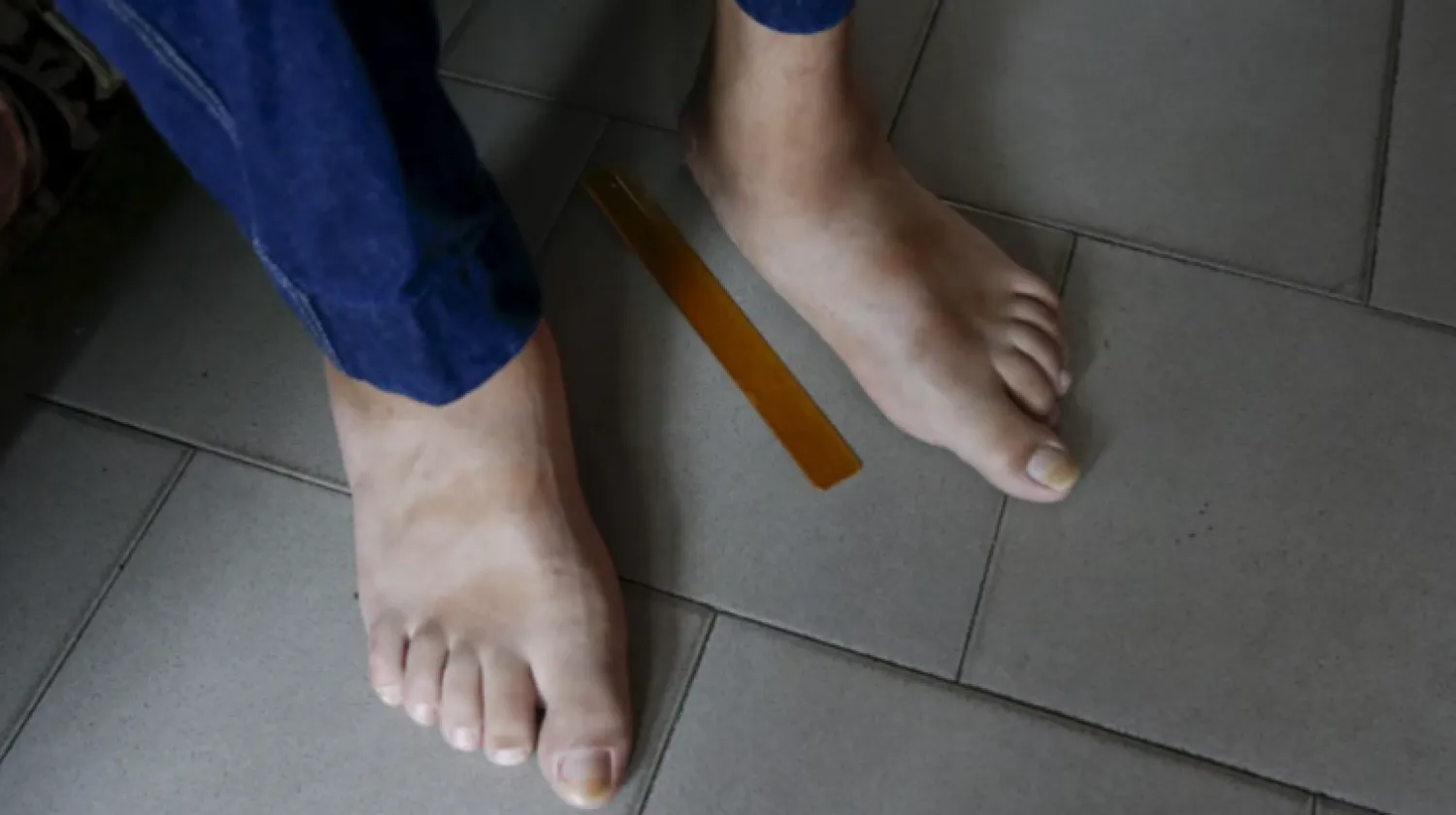 5 أمراض خطيرة قد تؤدي إلى تورم القدمين أثناء الليل