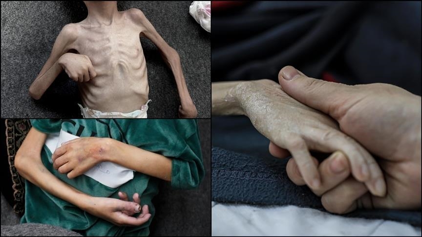 مسؤول صحي بغزة: اكتظاظ بعيادة لسوء التغذية والمجاعة في مرحلة حاسمة