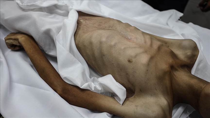 ارتفاع شهداء التجويع الإسرائيلي إلى 180 بينهم 93 طفلا