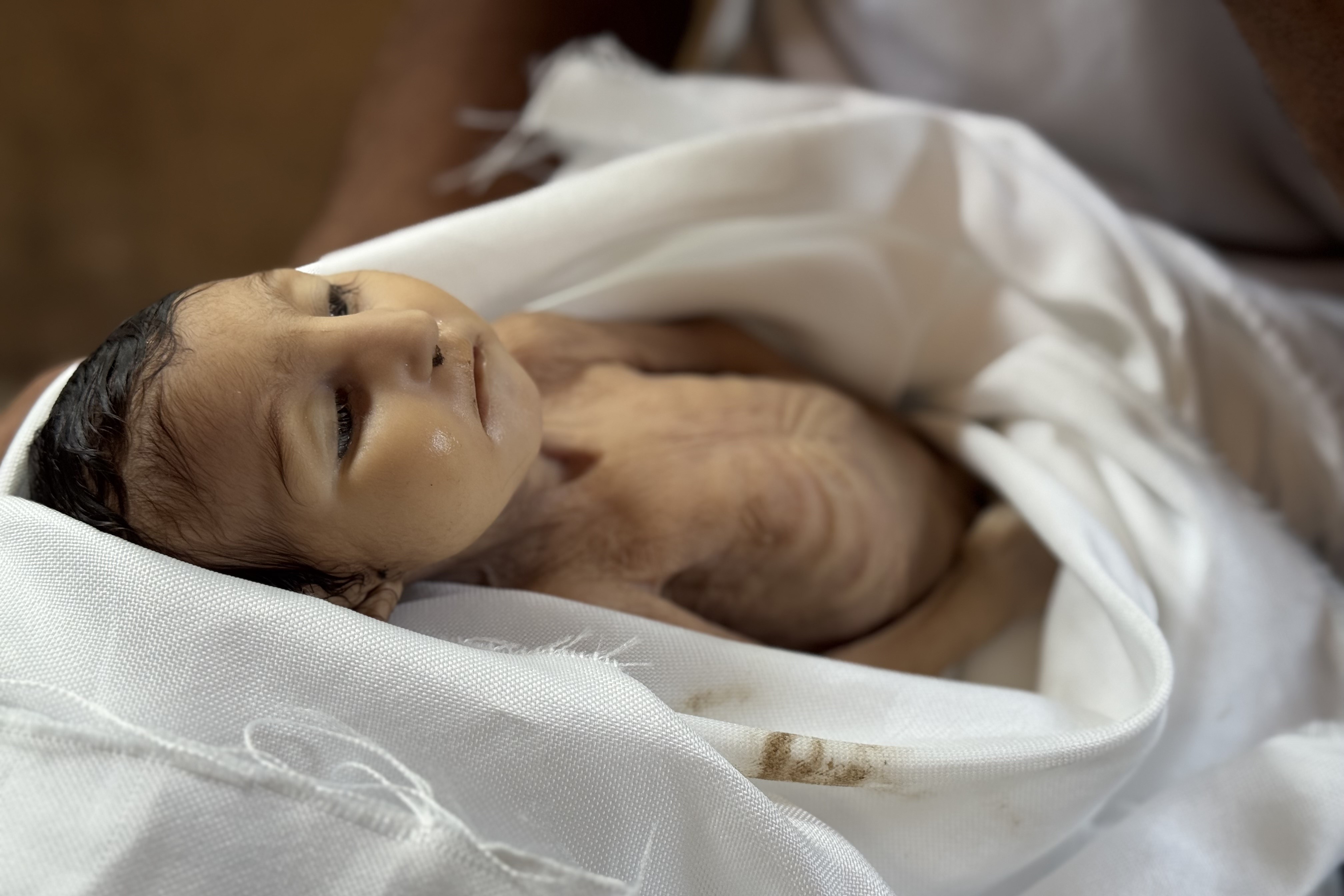 ضحية تجويع جديدة.. وفاة رضيعة جراء سوء التغذية في خان يونس