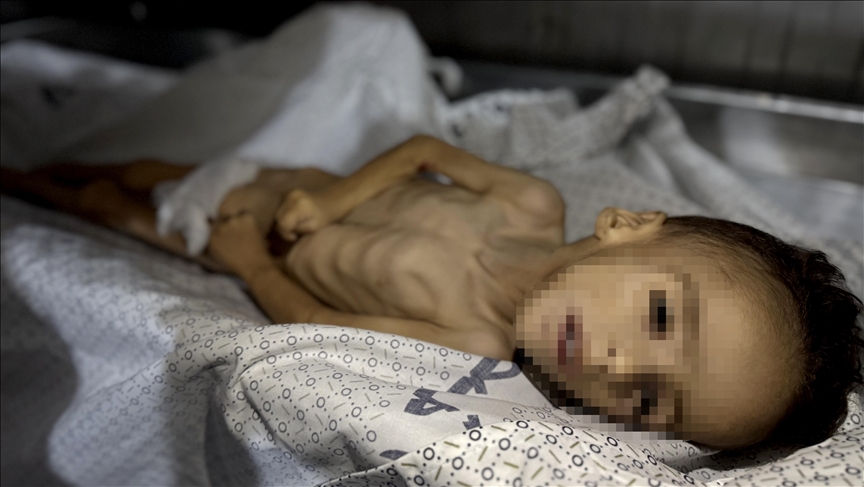 وفاة طفل في قطاع غزة نتيجة المجاعة وسوء التغذية