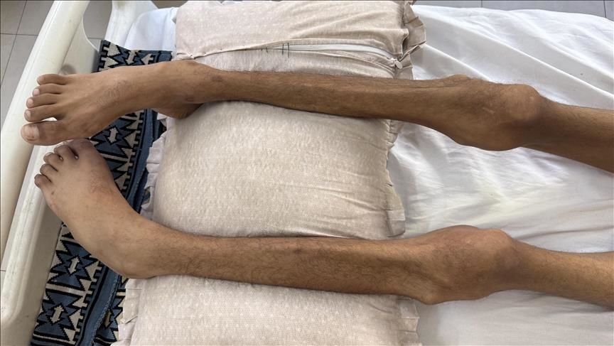 ارتفاع عدد شهداء التجويع الإسرائيلي إلى 435